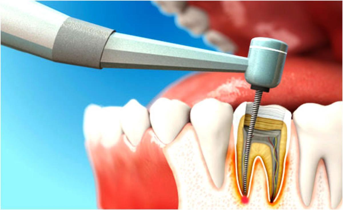 Стоматология бурова. Эндодонтическое перелечивание зубов. Что такое периодонтит в стоматологии. Стоматология рентген периодонтит.